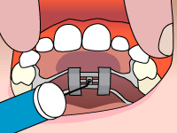 Rapid Palatal Expander (Palate Expander) - Yang Orthodontics
